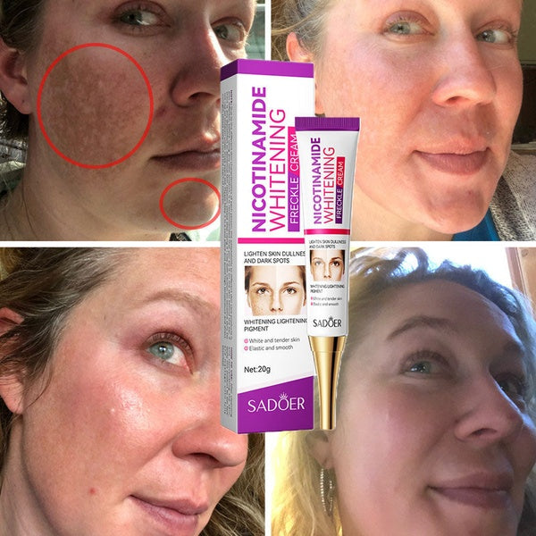 Nicotinamide Whitening Freckles Cream Remove Melasma Dark Spot Acne Marks Lightening Melanin Brightens Skin Tone Face Skin Care - GlowLaa.com