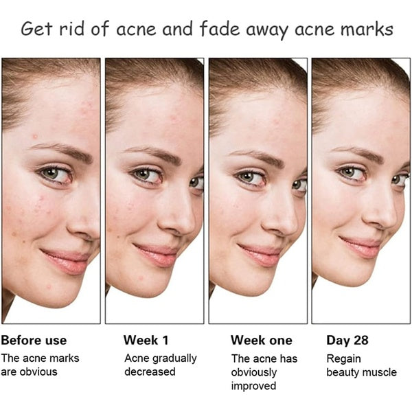 Aichun Beauty Anti - Acne Whitening Facial Serum Aloe Vera Extract Salicylic Acid Repairs Damaged Skin | 30ml