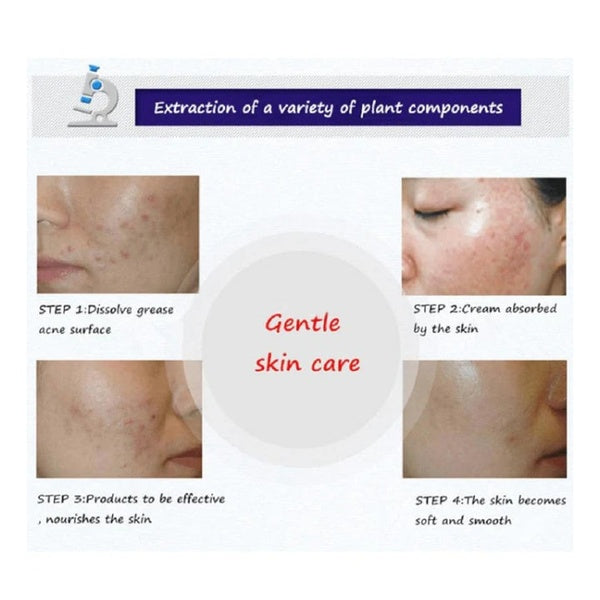 BIOAQUA Anti Acne Cleanser For Removal Of Acne - 100ml - GlowLaa.com