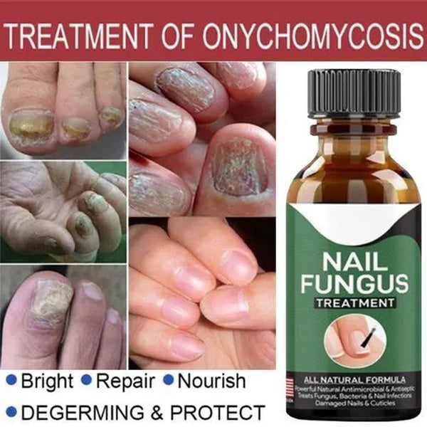 Fast Nail Fungal Treatments Nail Repair Essences Serum Care Treatments Foot Nail Fungus Removal Gel - GlowLaa.com