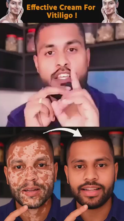 Fivfivgo Vitigo Bee Venom Correcting Cream 20g | Skin Tone Balancing And Pigmentation Repair Cream For Even, Healthy-Looking Skin